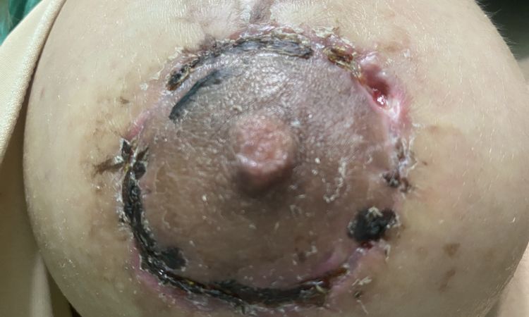 Pexia mamaria se abre al retirar los puntos - 44155