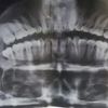 Ortodoncia con raíces cortas