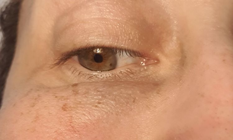 Bulto tras 2 años de relleno de ojeras con ac. hialurónico - 44600