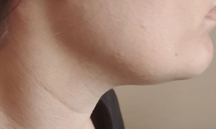 ¿Mejor tratamiento para definir quijada y disminuir arrugas en el cuello? - 44605