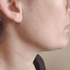 ¿Mejor tratamiento para definir quijada y disminuir arrugas en el cuello?