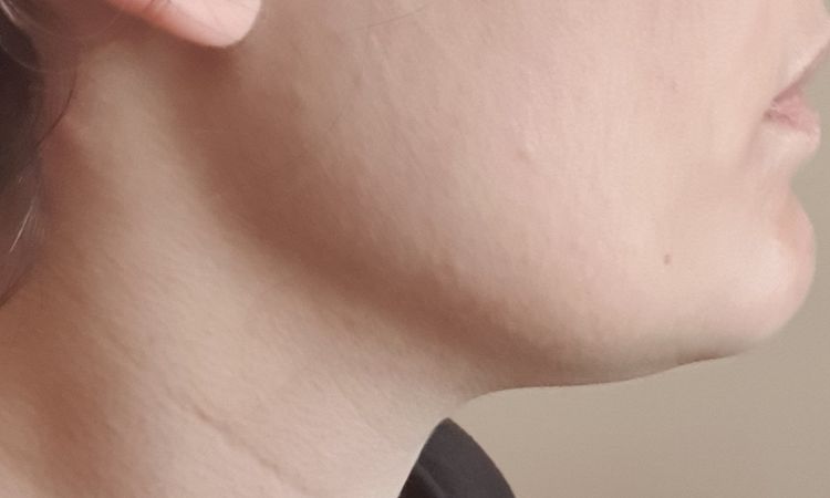 ¿Mejor tratamiento para definir quijada y disminuir arrugas en el cuello? - 44606