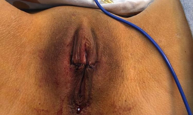 Labioplastía- Puntos abiertos ¿Que hago? - 46142