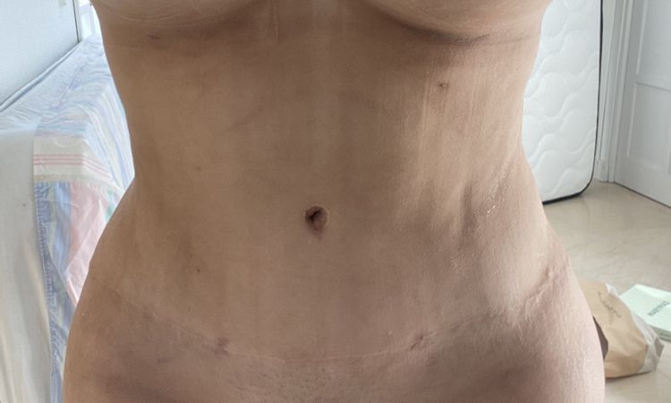 Qué láser es mejor Erbium YAG fotona dynamis o Laser CO2 Fraccionado - 46175