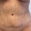 Qué láser es mejor Erbium YAG fotona dynamis o Laser CO2 Fraccionado