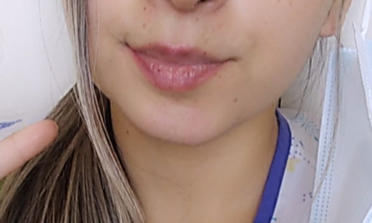 Retirar injerto de cartílago que me realizaron en una rinoplastia - 46631