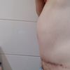 Malos resultados abdominoplastia y liposucción. ¿Posible solución?