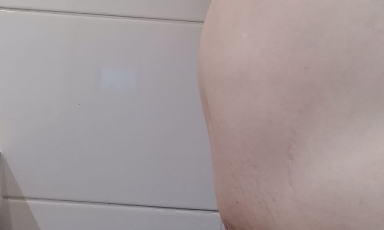 Malos resultados abdominoplastia y liposucción. ¿Posible solución? - 47185