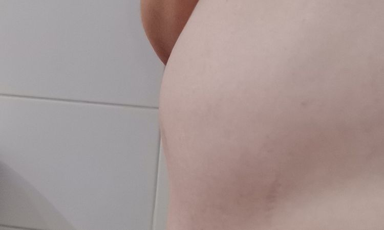 Malos resultados abdominoplastia y liposucción. ¿Posible solución? - 47187