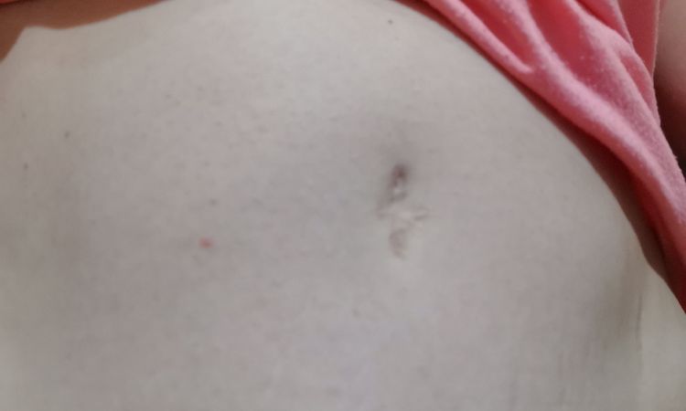 Malos resultados abdominoplastia y liposucción. ¿Posible solución? - 47188
