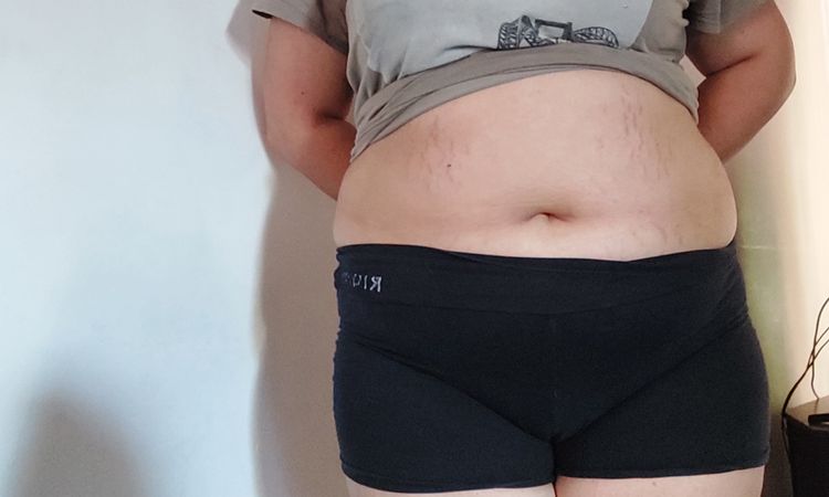 Lipo o abdominoplastia a mi hija menor de edad - 47562