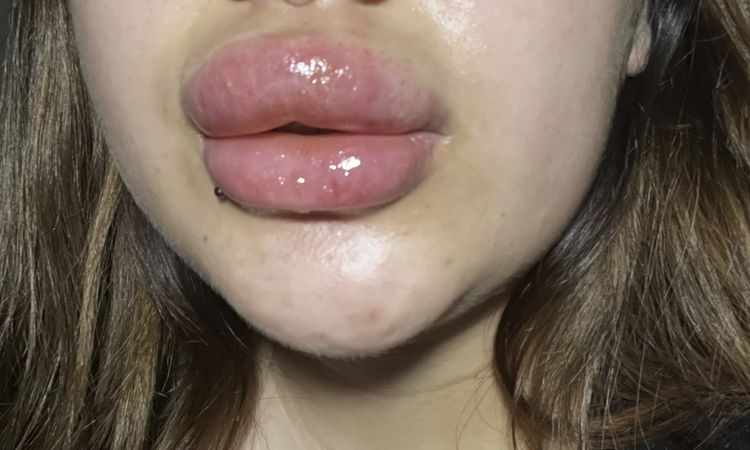 Labios hinchados post hyaluron pen - 47856