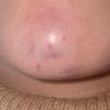 Dolor al hablar, comer y sonreír tras ácido hialurónico en mentón