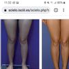 Lipotransferencia en piernas?