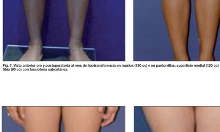 Lipotransferencia en piernas? - 48374