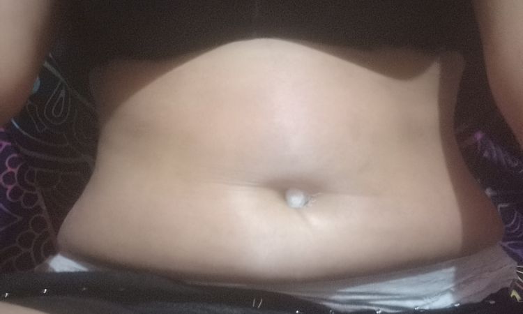 2 meses de abdominoplastia pero con mucho abdomen y suelto - 48841