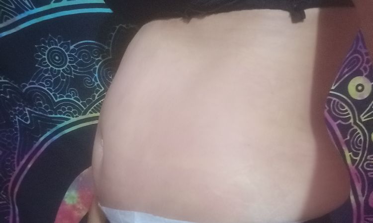2 meses de abdominoplastia pero con mucho abdomen y suelto - 48843