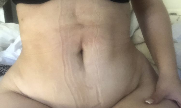 Abdomen bajo caído después de una mini abdominoplastia - 48893