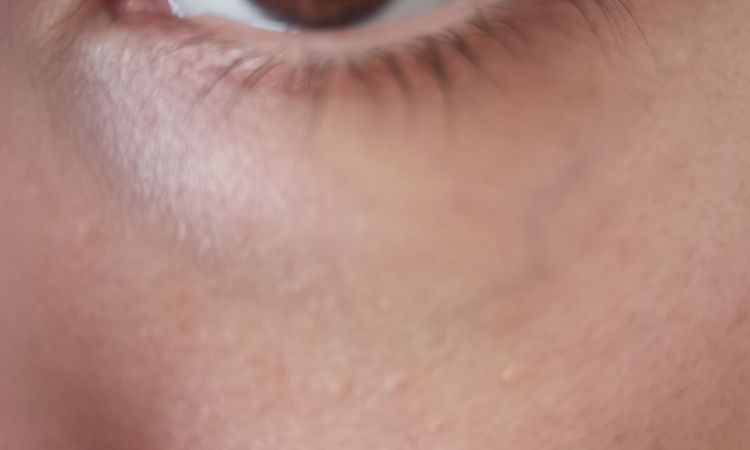 Tratamiento laser o ácido hialurónico en ojeras - 49029