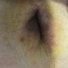 Ombligo oscuro luego de una mini abdominoplastia