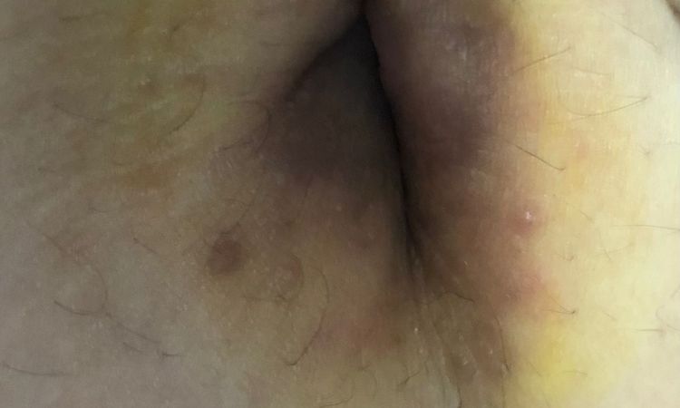 Ombligo oscuro luego de una mini abdominoplastia - 49180