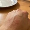 Tratamiento para sarpullido en la mano