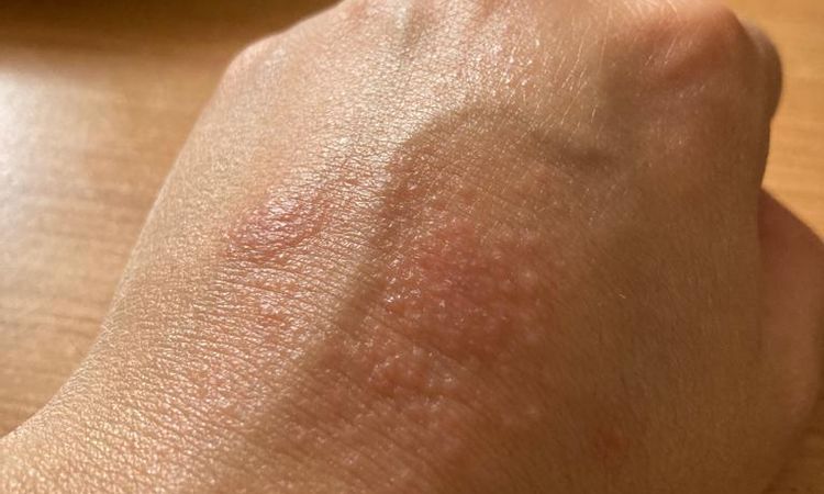 Tratamiento para sarpullido en la mano - 49204