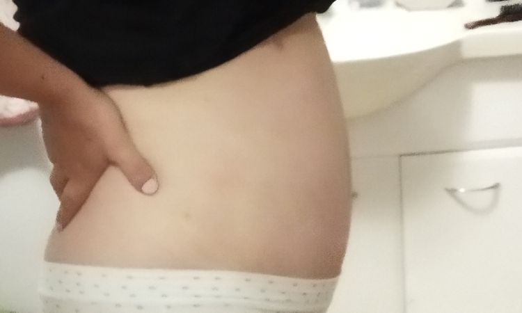 Mi panza salió afuera después de 3 semanas de abdominoplastia - 49768