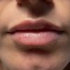 Bultos en labios tras aplicar ácido hialurónico