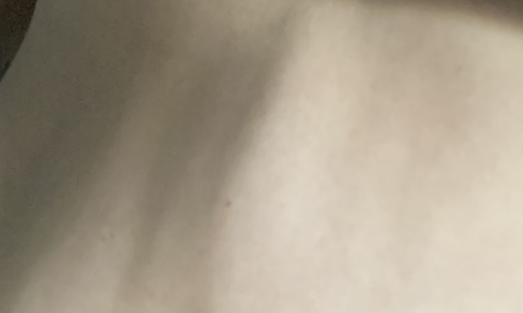 Bulto en abdomen después de 4 meses lipo abdominoplastia - 51221