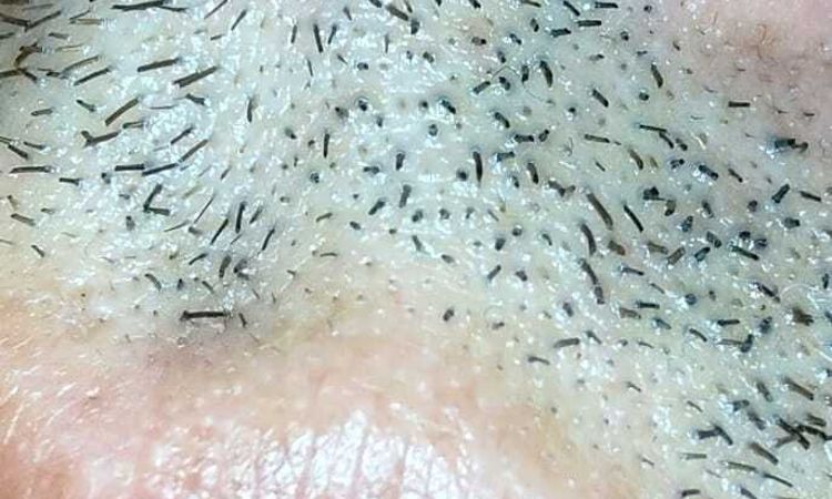 Posible infección en post operatorio Rinoplastia - 51463