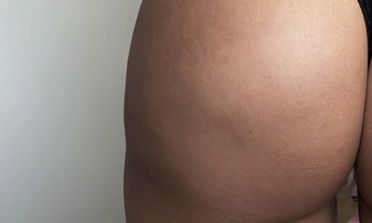 Manchas y bultos en glúteos tras lipotransferencia - 51772
