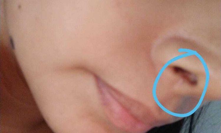 Dudas sobre el resultado de mi rinoplastia - 52782