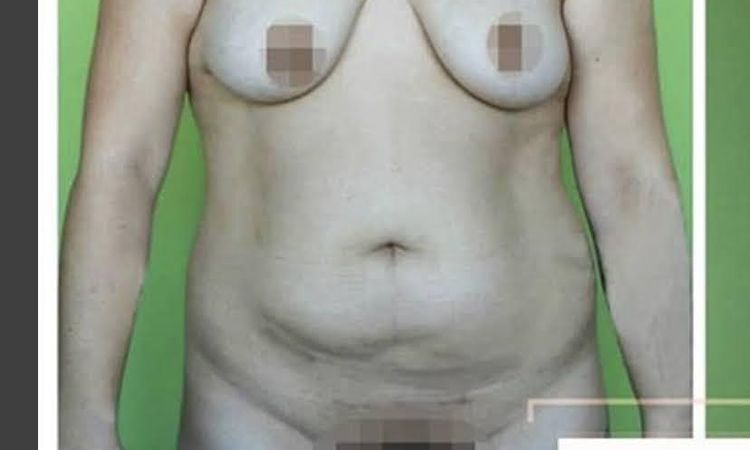 Cómo arreglar cicatriz queloide y dolores post abdominoplastia - 52990