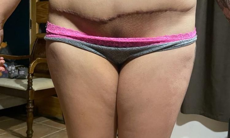 Cómo arreglar cicatriz queloide y dolores post abdominoplastia - 52991