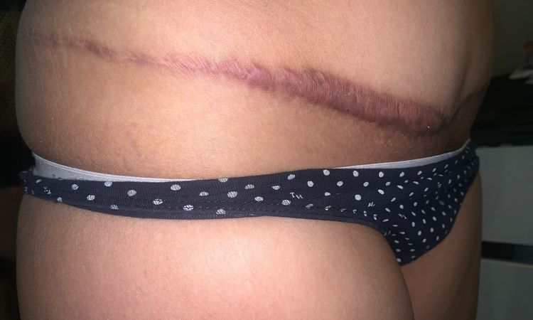 Cómo arreglar cicatriz queloide y dolores post abdominoplastia - 52992