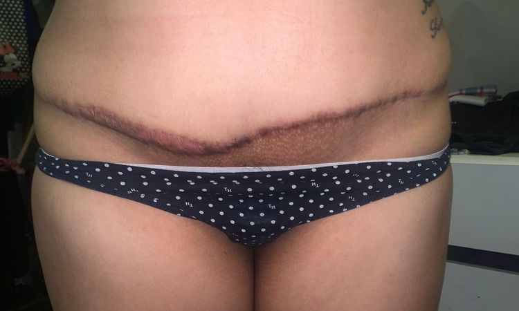 Cómo arreglar cicatriz queloide y dolores post abdominoplastia - 52994