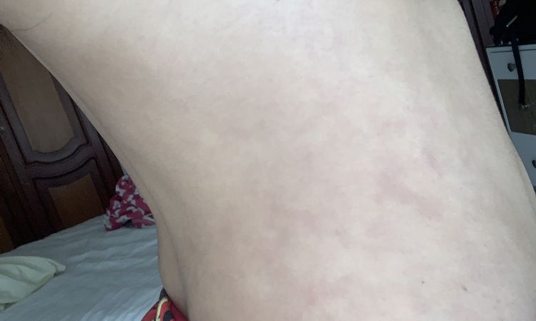 Manchas después de un año de mi lipoescultura - 53020