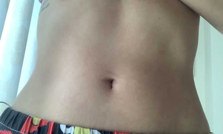 Manchas después de un año de mi lipoescultura - 53021