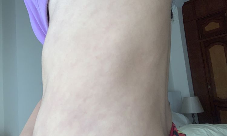Manchas después de un año de mi lipoescultura - 53022
