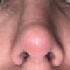 Tras 9 meses de cirugía, ¿necesito rinoplastia secundaria o mi nariz mejorará?