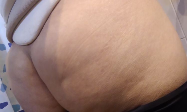 Glúteos deformes después de lipotransferencia grasa - 53808