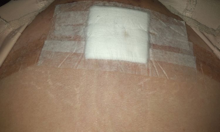 Glúteos deformes después de lipotransferencia grasa - 53809