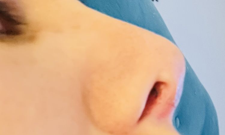 Punta de nariz muy alta tras rinoplastia - 53881