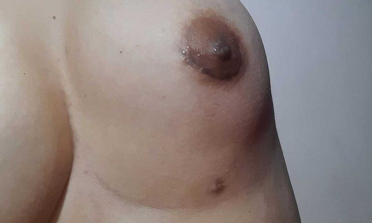 Corregir piel flácida tras liposucción y mamas descolgadas - 54723