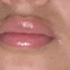 Labios duros y asimétricos después de 6 días de aumento de labio
