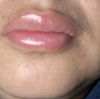 Labios duros y asimétricos después de 6 días de aumento de labio