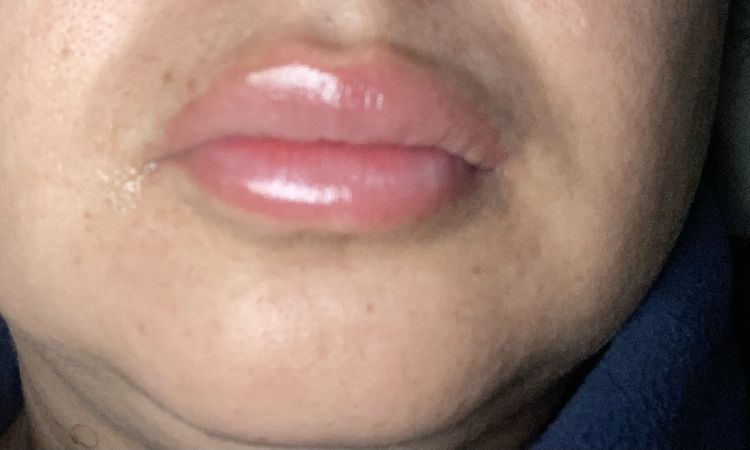 Labios duros y asimétricos después de 6 días de aumento de labio - 55019