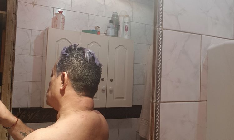 Corregir lipodistrofia en el cuello - 55469
