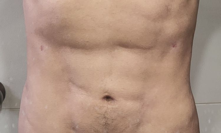 Tratamiento Fibrosis y eliminación marcación HD - 56460